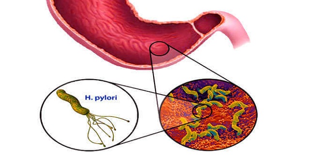 Helicobacter pylori 1