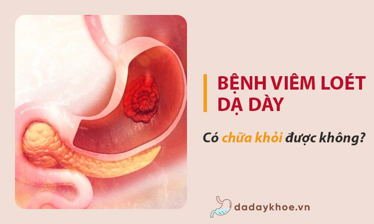 Viêm loét dạ dày có chữa khỏi được không? bao lâu chữa khỏi?