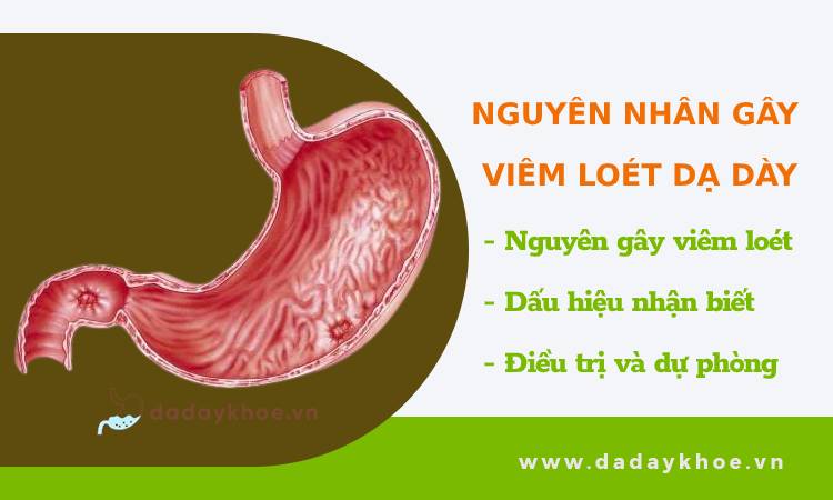 7 nguyên nhân gây viêm loét dạ dày mà bạn tiếp xúc hằng ngày