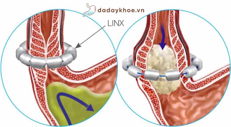 2. Phẫu thuật tăng cường cơ thắt thực quản dưới (Linx) 1