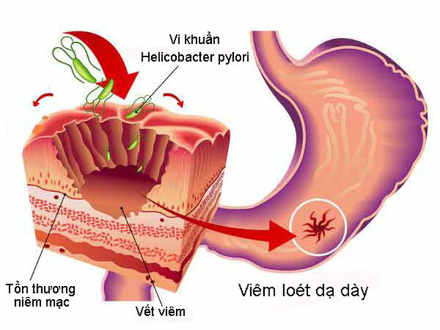 Vi khuẩn Hp (Helicobacter pylori) - Tác nhân chính gây viêm loét dạ dày 1