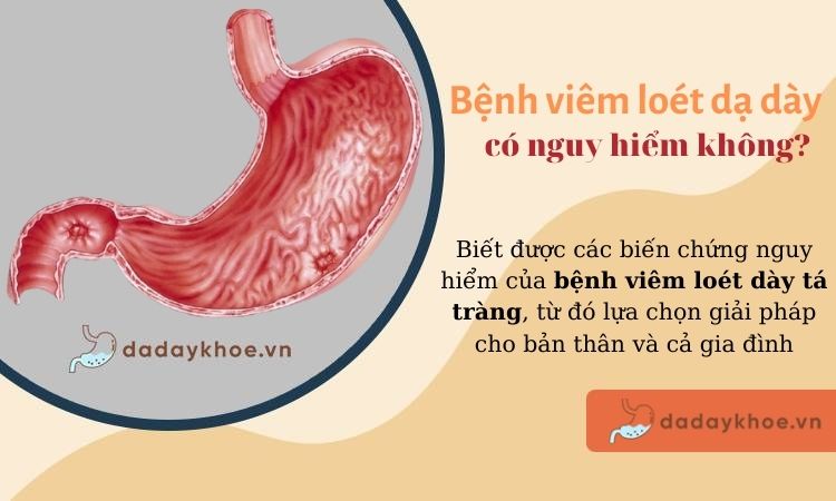 4 biến chứng cực kỳ nguy hiểm của bệnh viêm loét dạ dày tá tràng