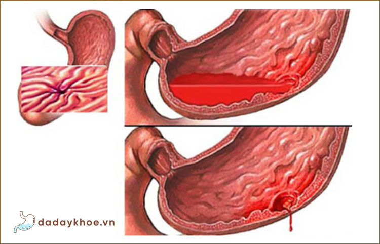 Triệu chứng các tổn thương gây xuất huyết do viêm loét dạ dày 1
