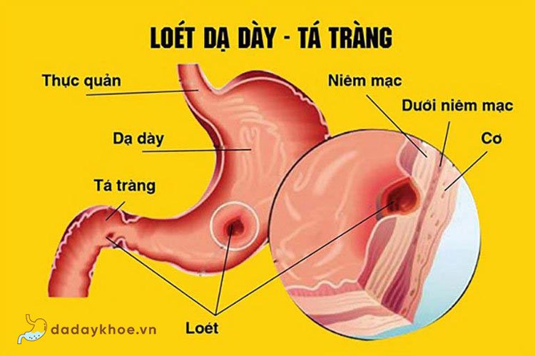 Bệnh viêm loét dạ dày: Nguyên nhân, triệu chứng và cách điều trị