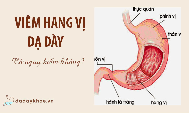 Viêm hang vị dạ dày có nguy hiểm không - Giải đáp chi tiết!