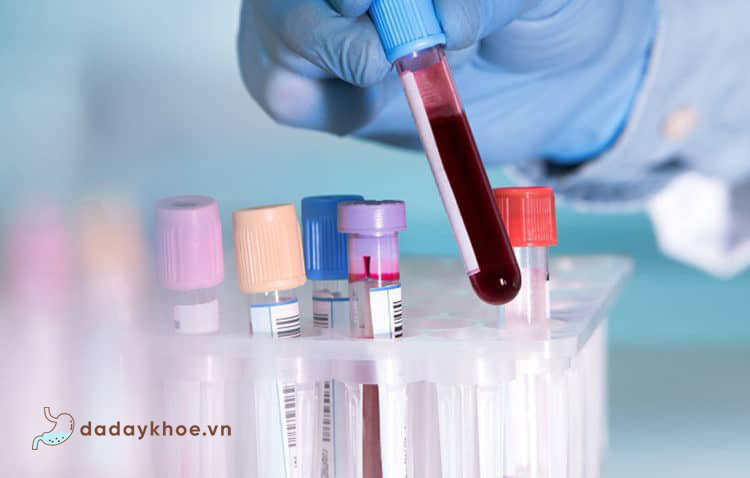 2. Xét nghiệm máu tìm vi khuẩn Hp 1