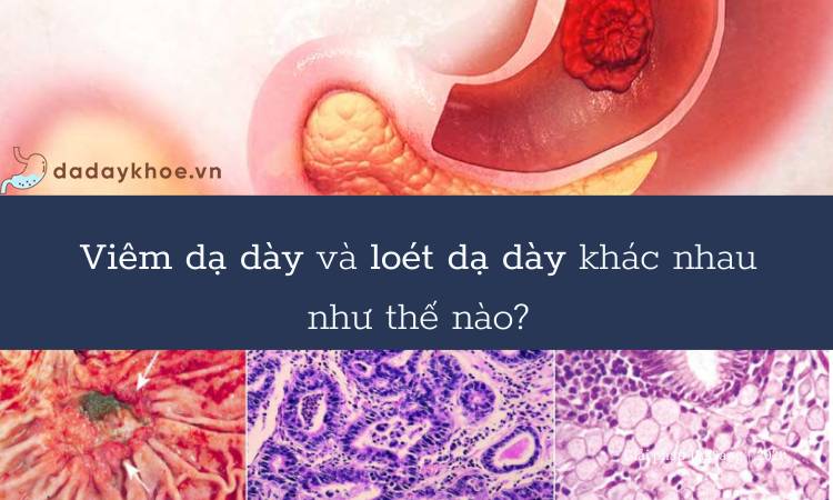 [A-Z] viêm dạ dày và loét dạ dày khác nhau như thế nào?