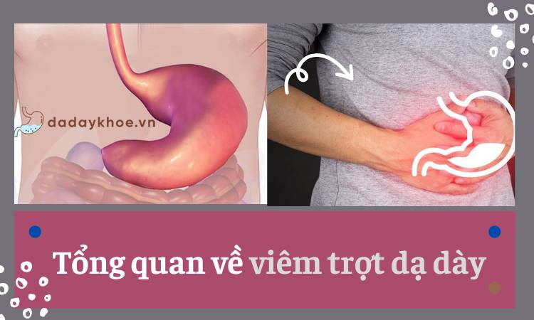 Viêm trợt niêm mạc dạ dày là gì? Nguy hiểm mức độ mấy?