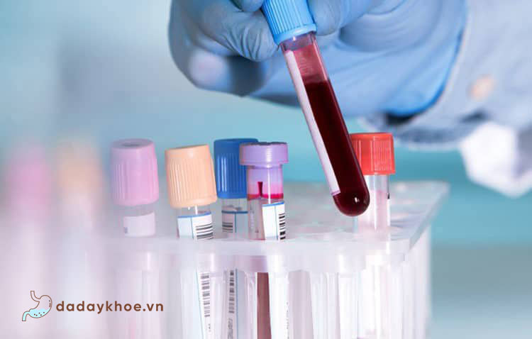 1. Xét nghiệm máu chẩn đoán Hp 1